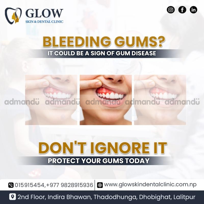 Advanced Gum Treatment in Kathmandu, Nepal